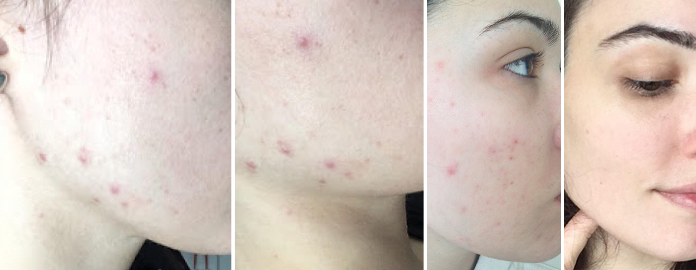 Skin Transformation Story: Regan Barwick