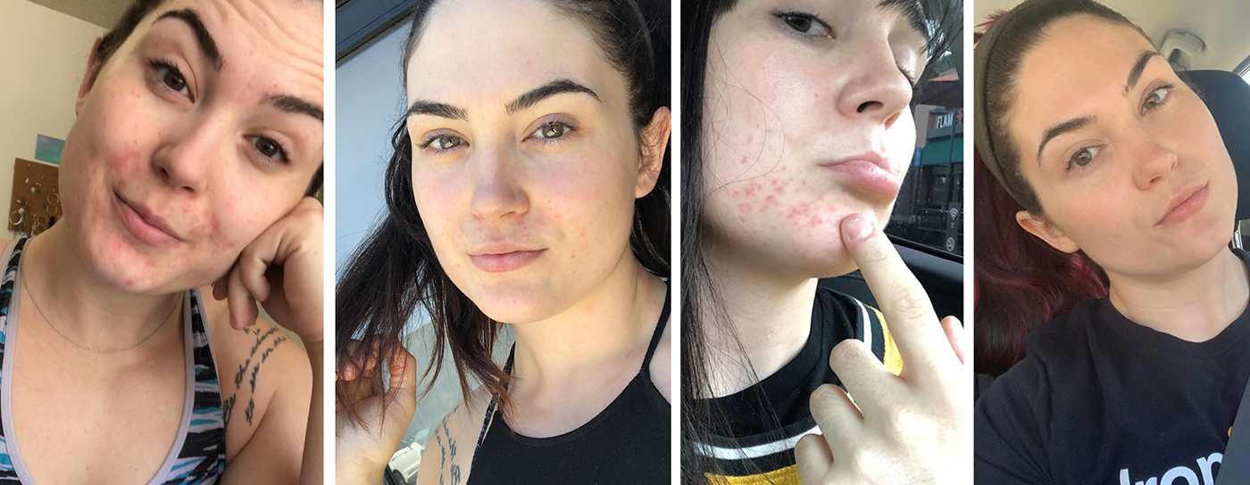 Skin Transformation Story: Ciarra Hutton