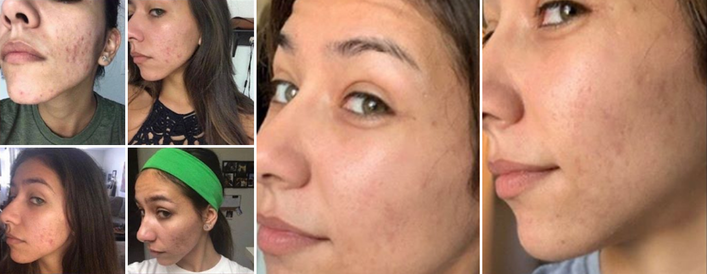Skincare Transformation Story: Sammie Garcia